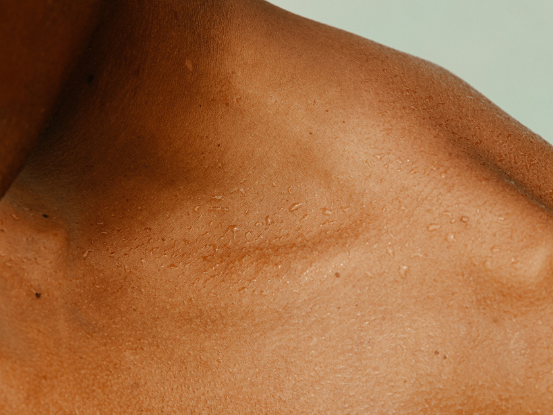 Acanthosis Nigricans