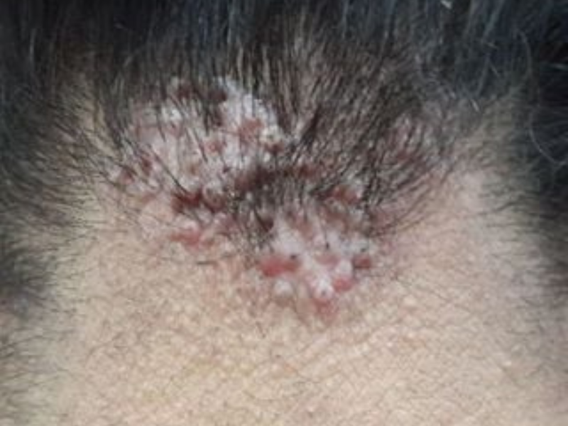 Acne Keloidalis Nuchae