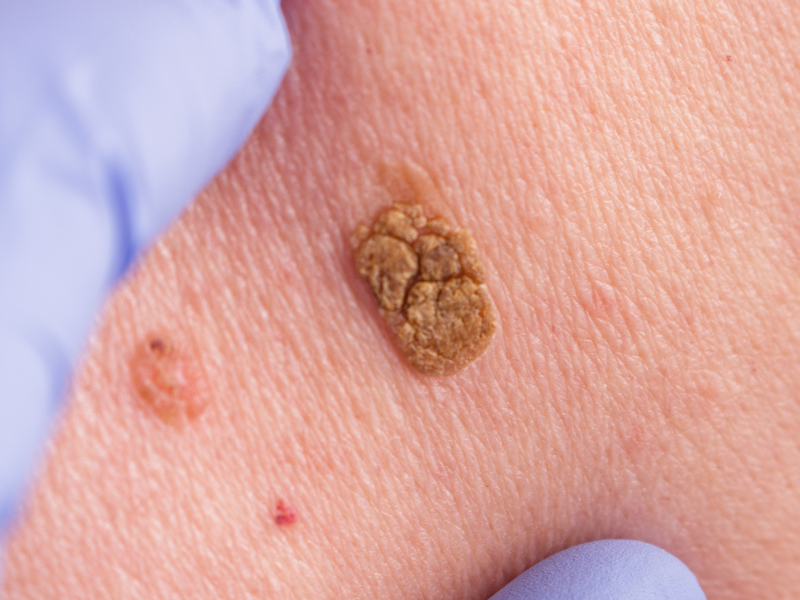 Actinic Keratoses