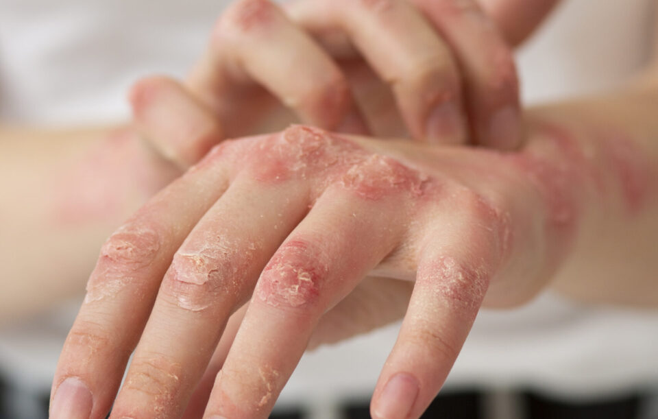 Atopic Dermatitis
