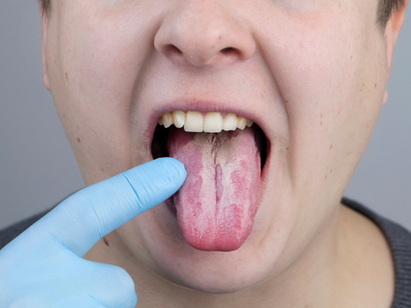 Candidiasis