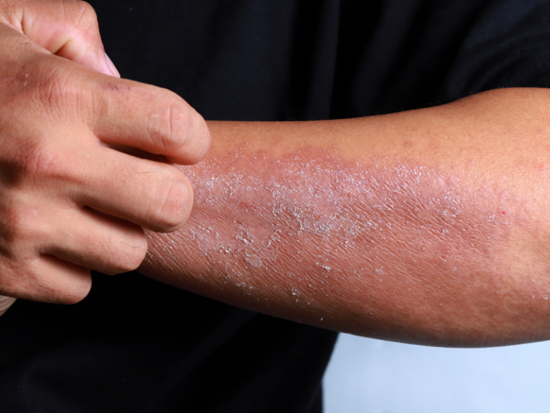 Cellulitis