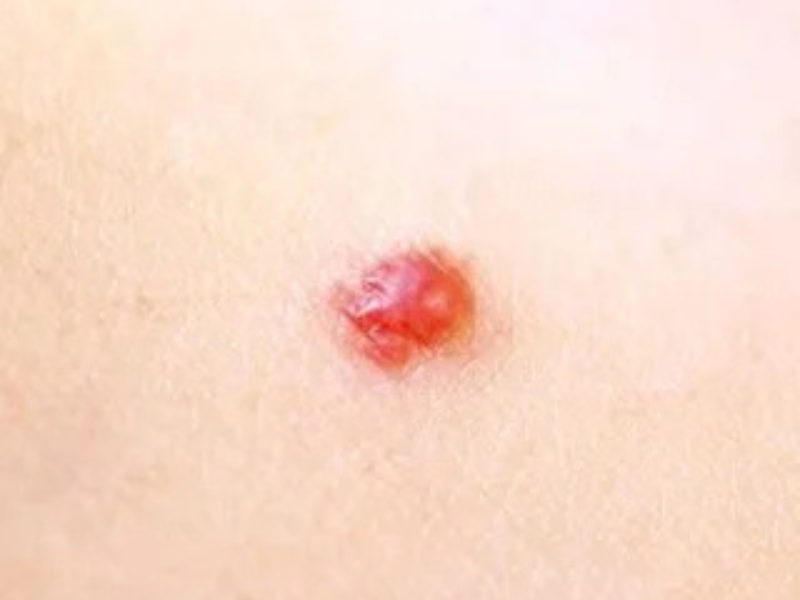 Cherry Angiomas