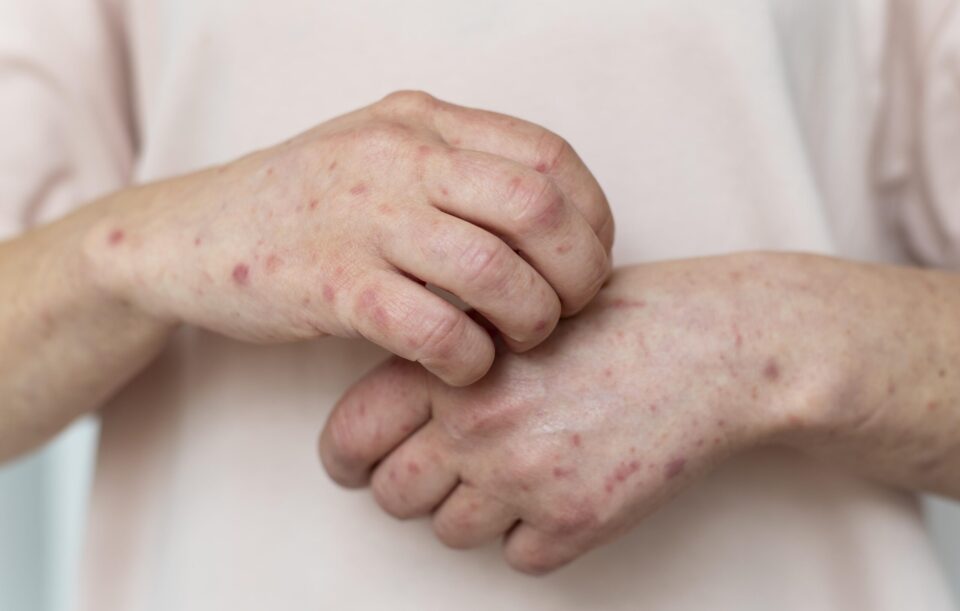 Contact Dermatitis