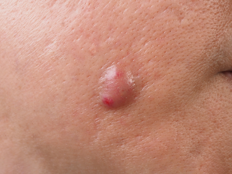 Cysts-skin