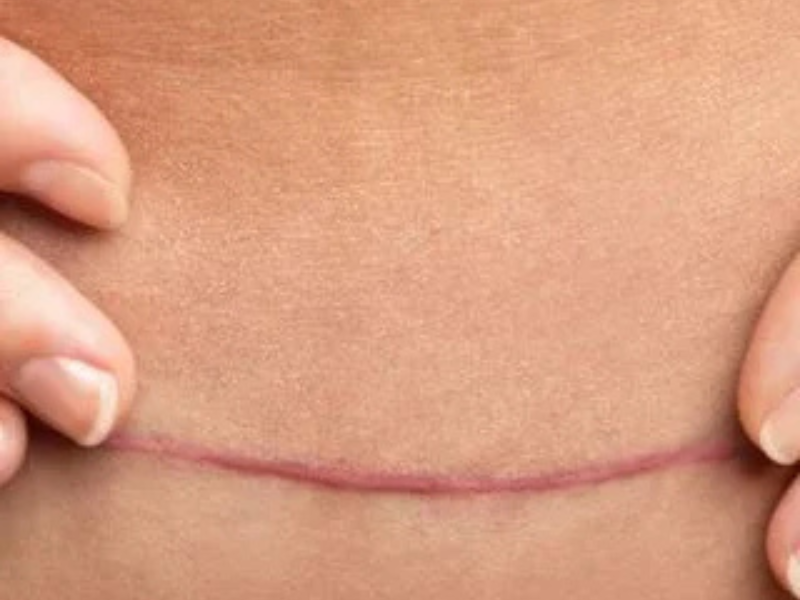 Hypertrophic Scars