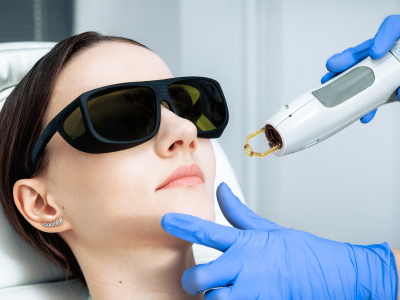 Intense Pulsed Light (IPL)