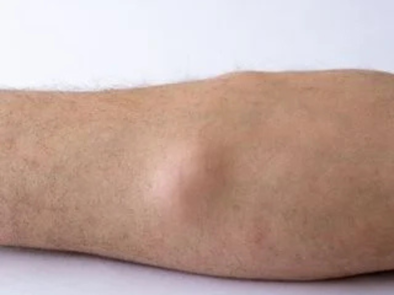 Lipoma