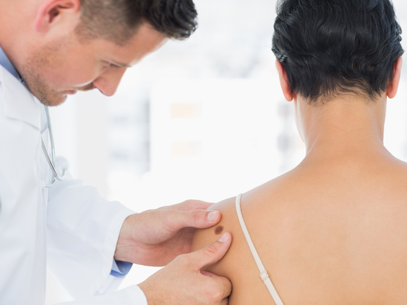Melanoma