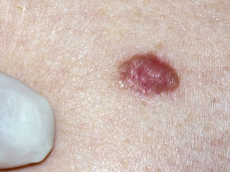 Merkel Cell Carcinoma