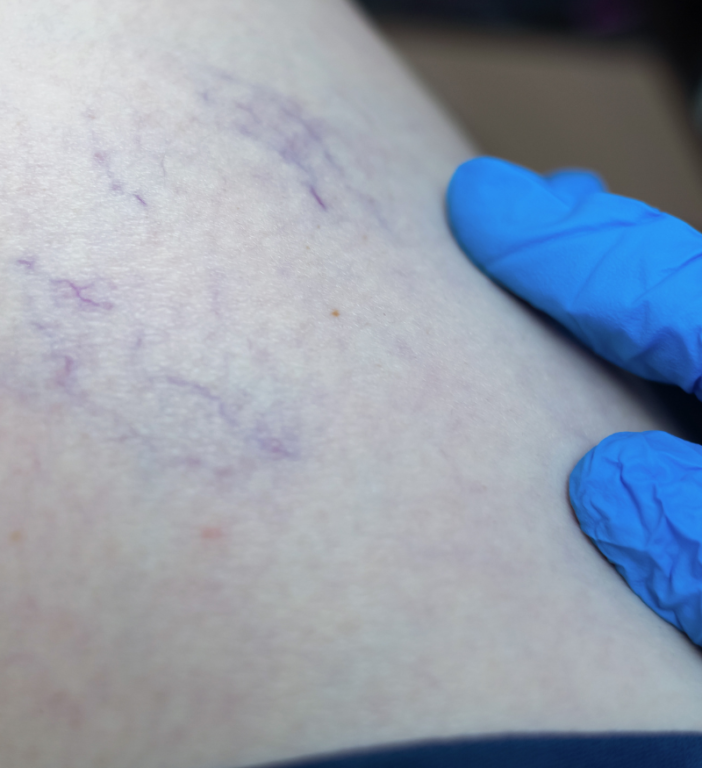 Sclerotherapy-idh