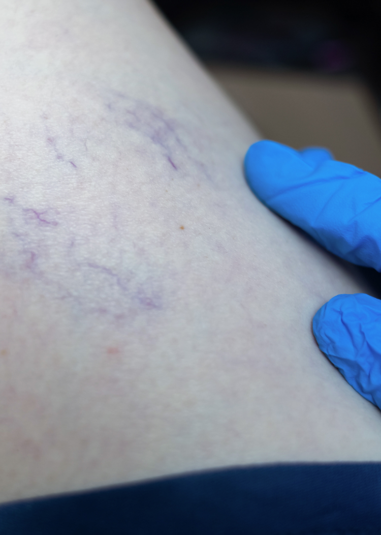 Sclerotherapy-idh Sclerotherapy-idh