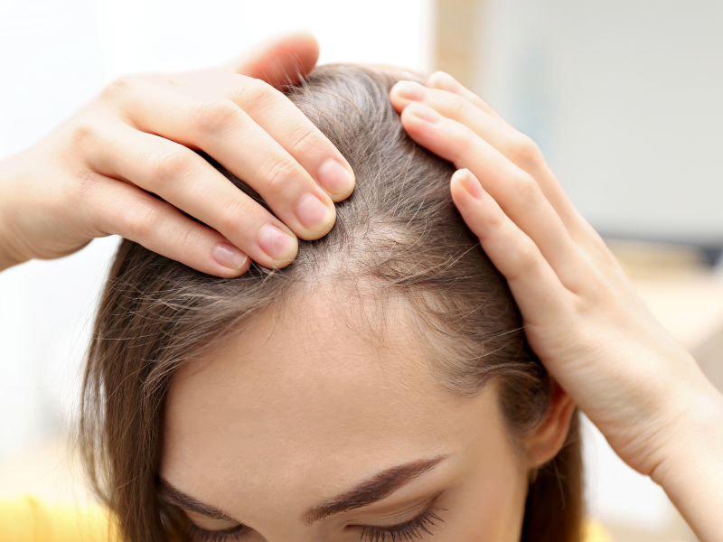 Traction Alopecia