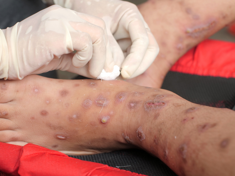 pus-filled bump