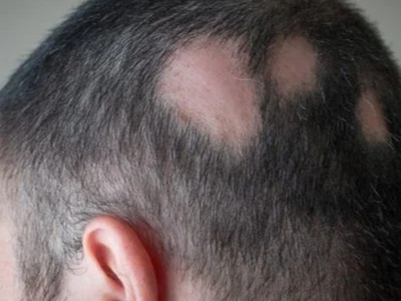 Alopecia Areata