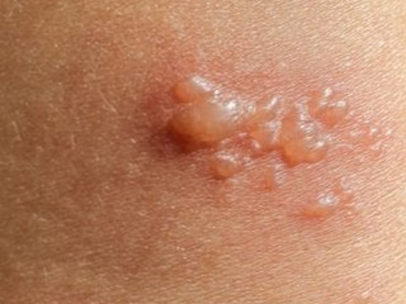 Bullous Pemphigoid
