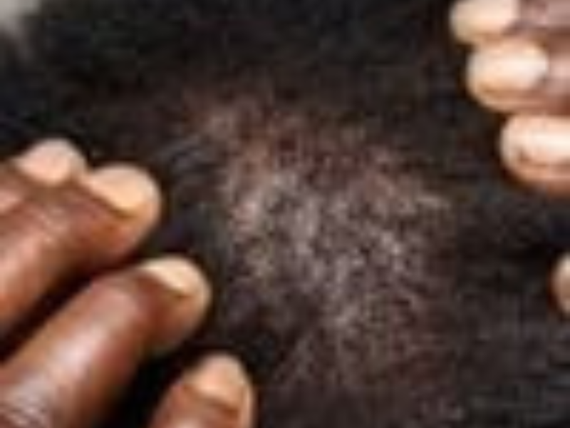 Central Centrifugal Cicatricial Alopecia