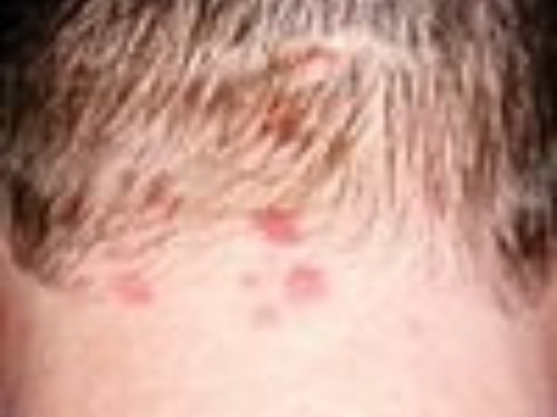 Dermatitis Herpetiformis
