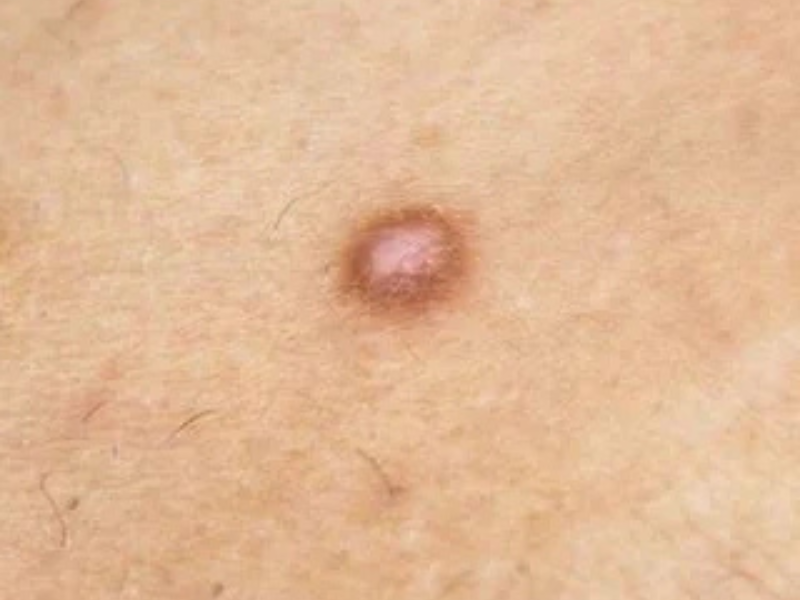 Dermatofibroma