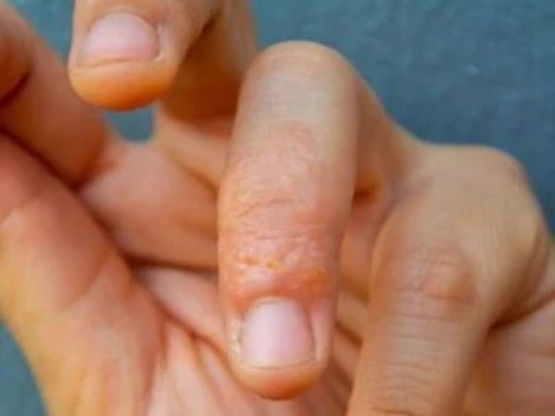 Dyshidrotic Eczema