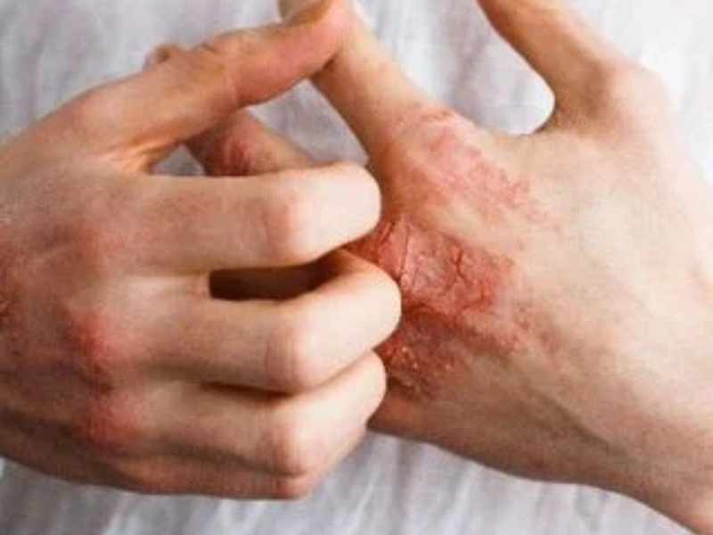 Eczema (Dermatitis)