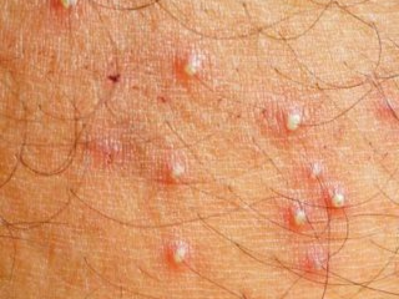 Folliculitis