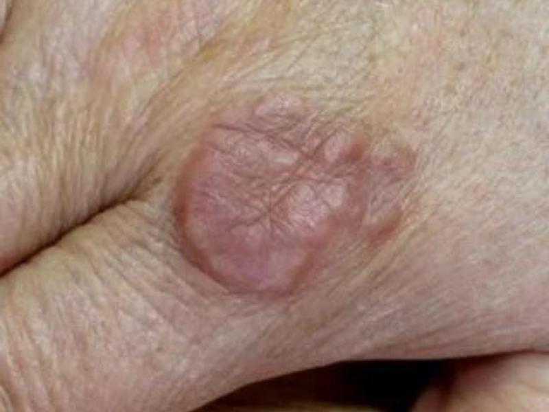 Granuloma Annulare