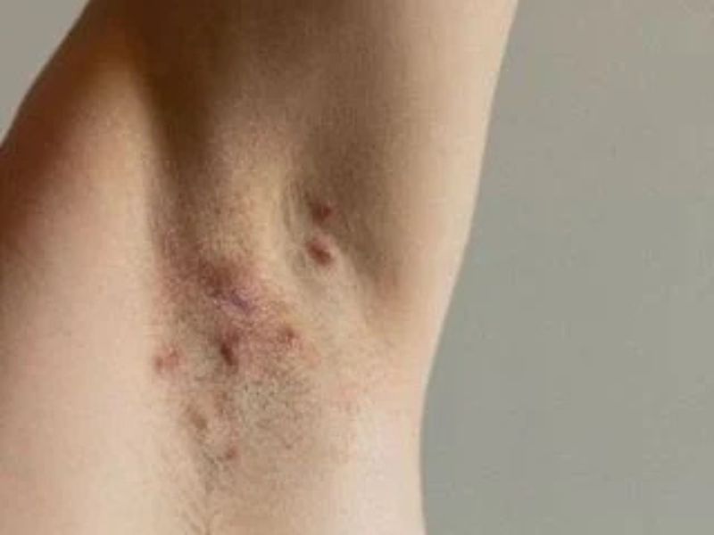 Hidradenitis Suppurativa