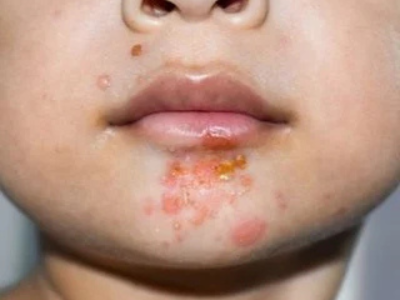 Impetigo