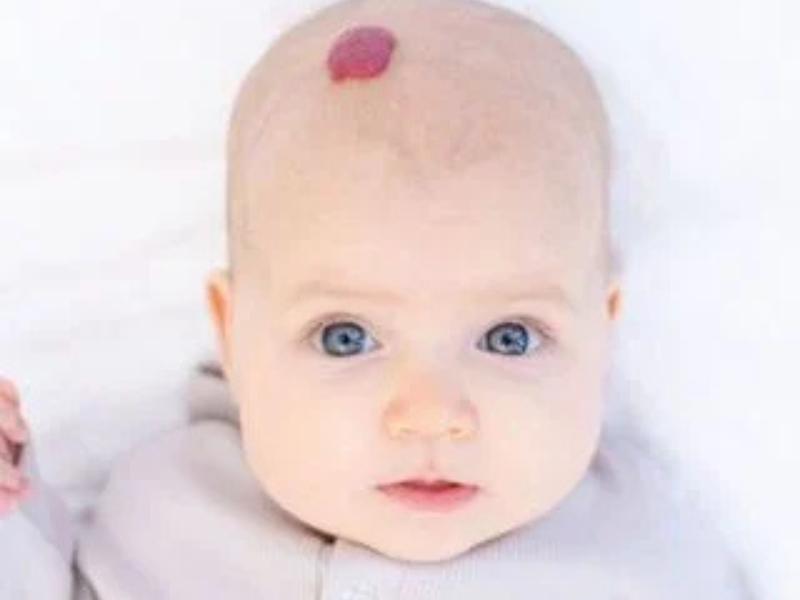 Infantile Hemangiomas