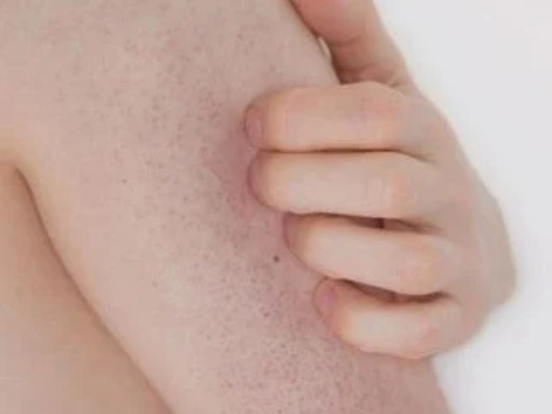 Keratosis Pilaris
