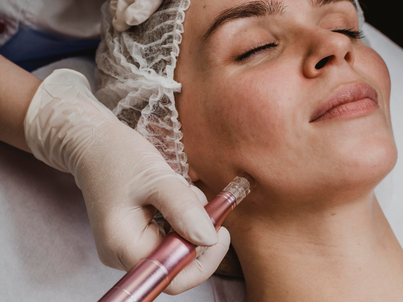 Laser Skin Resurfacing