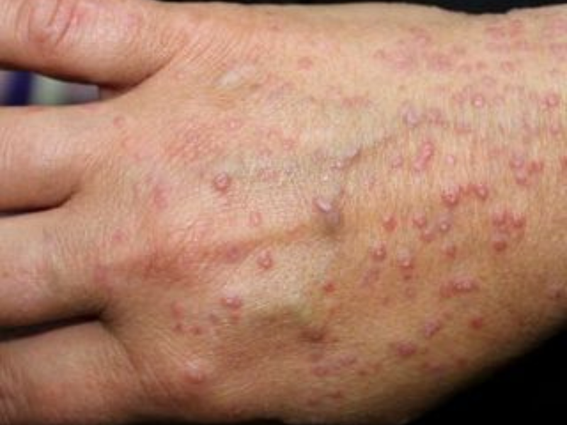 Lichen Planus