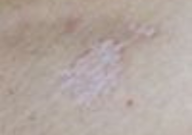 Lichen Sclerosus