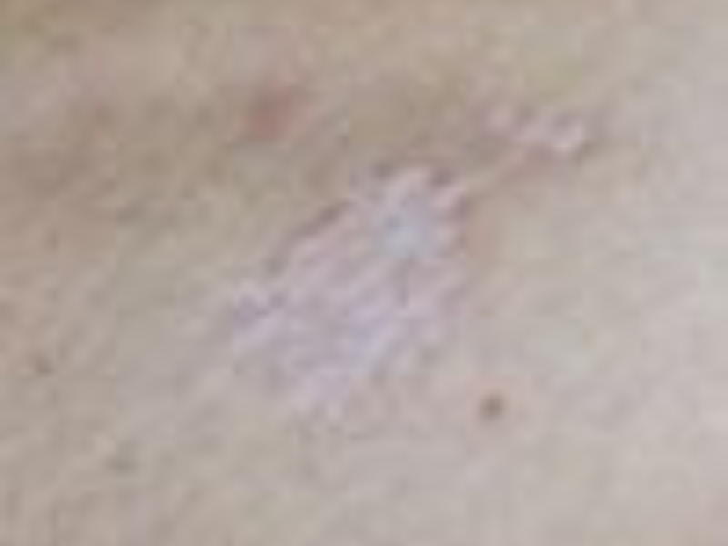 Lichen Sclerosus