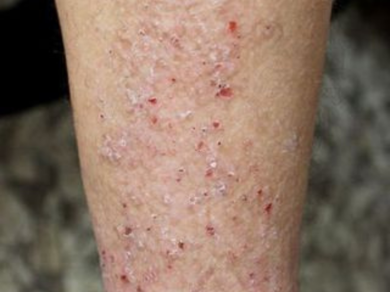 Lichen Simplex Chronicus