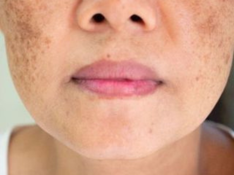 Melasma