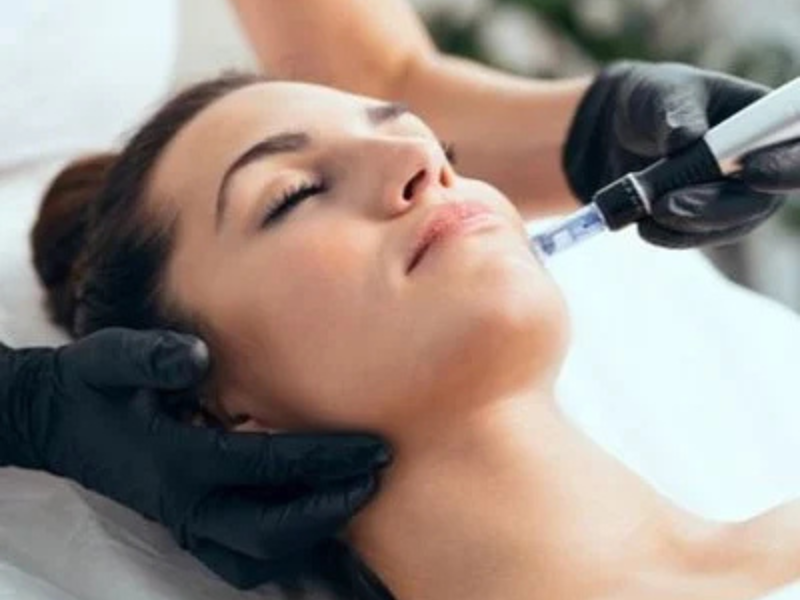 Microneedling