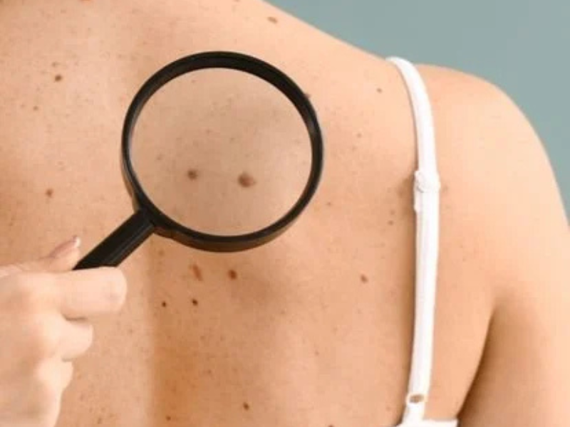 Moles (Nevi)