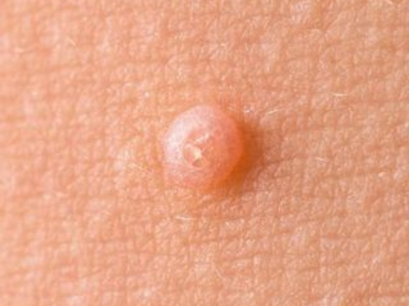 Molluscum Contagiosum
