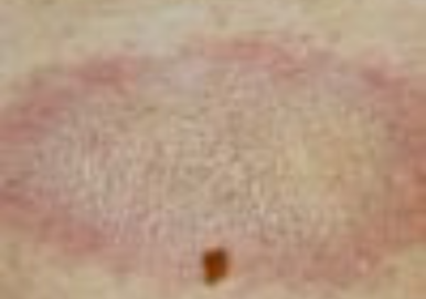 Morphea (Localized Scleroderma)