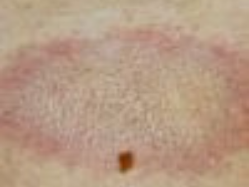 Morphea (Localized Scleroderma)