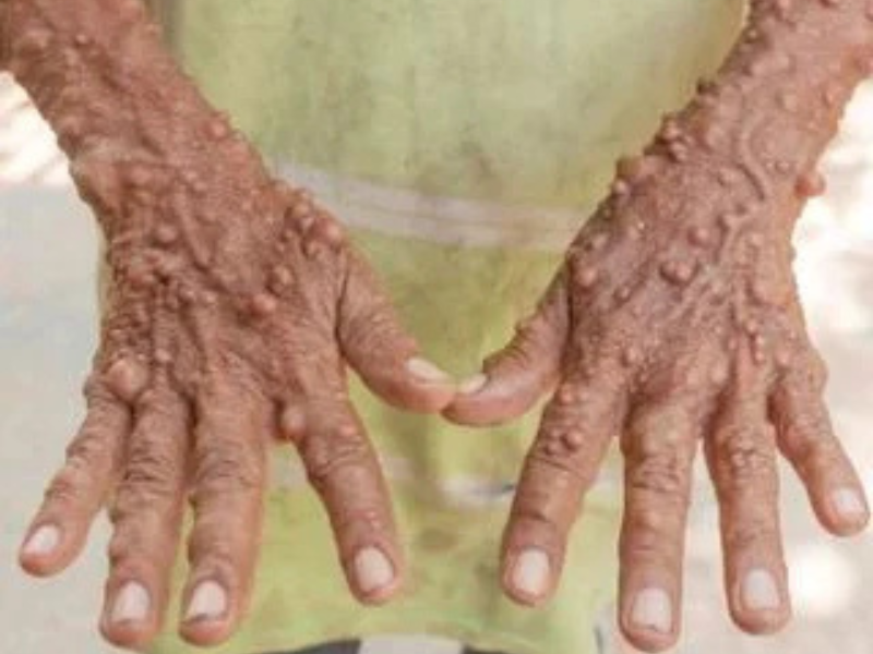 Neurofibroma