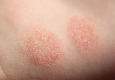 Nummular Dermatitis