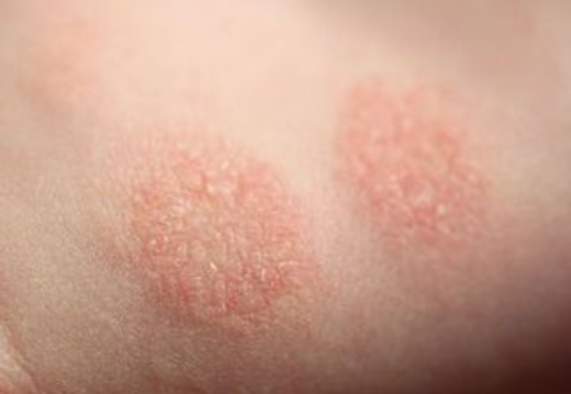 Nummular Dermatitis