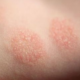 Nummular Dermatitis