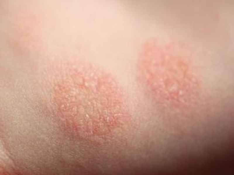 Nummular Dermatitis