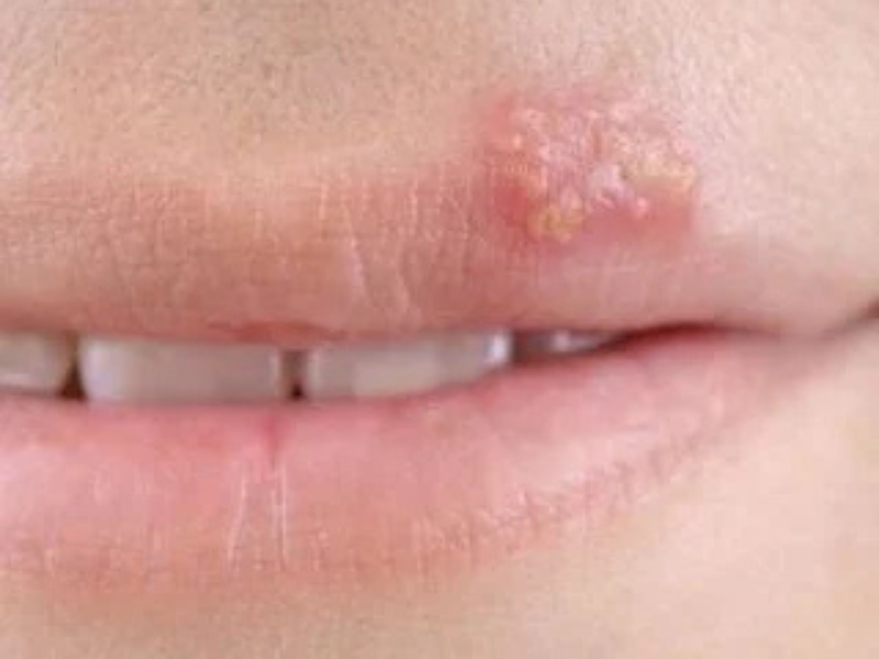 Oral Herpes (Herpes Simplex Labialis, Cold Sores, Fever Blisters)