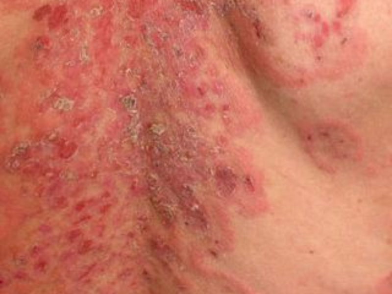 Pemphigus
