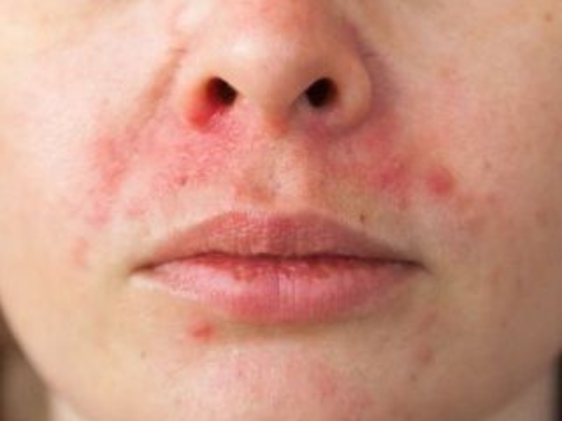 Perioral Dermatitis
